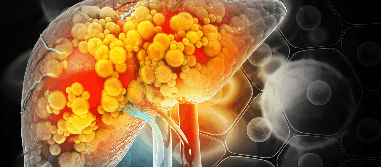fatty liver in young people