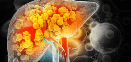 fatty liver in young people