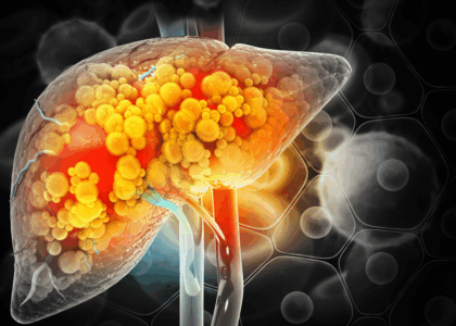 fatty liver in young people