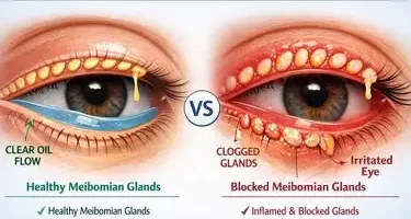 Meibomian Gland Dysfunction