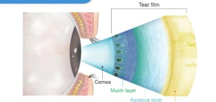 Why Do Your Eyes Water When They’re Actually Dry? Understanding Reflex Tearing