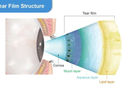 Why Do Your Eyes Water When They’re Actually Dry? Understanding Reflex Tearing